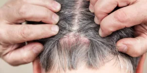 scalp infection